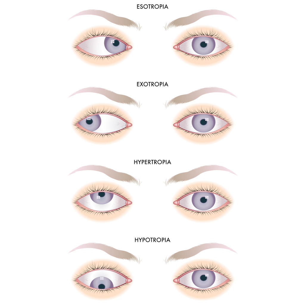 Какой глаз левый а какой правый. Сходящееся косоглазие. Занятия для глаз косоглазие. Косоглазие экзотропия. Легкая форма косоглазия.